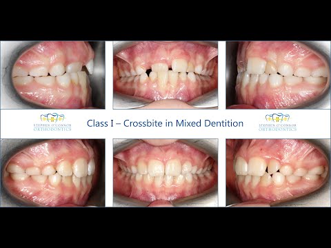 Class I occlusion - Crossbite in Mixed Dentition - Interceptive treatment with Removable Appliance