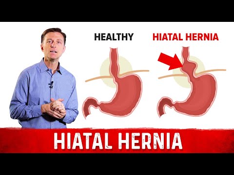 Quick Fix For Hiatal Hernia – Dr. Berg