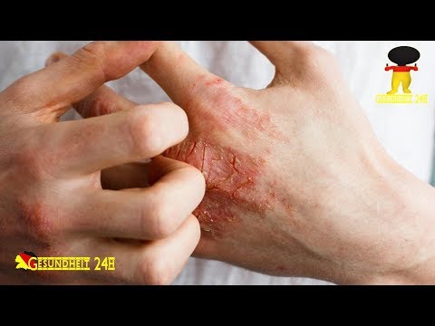 Die erfolgreiche Behandlung der Schuppenflechte Atopitscheski die Hautentzündung luule wiilma