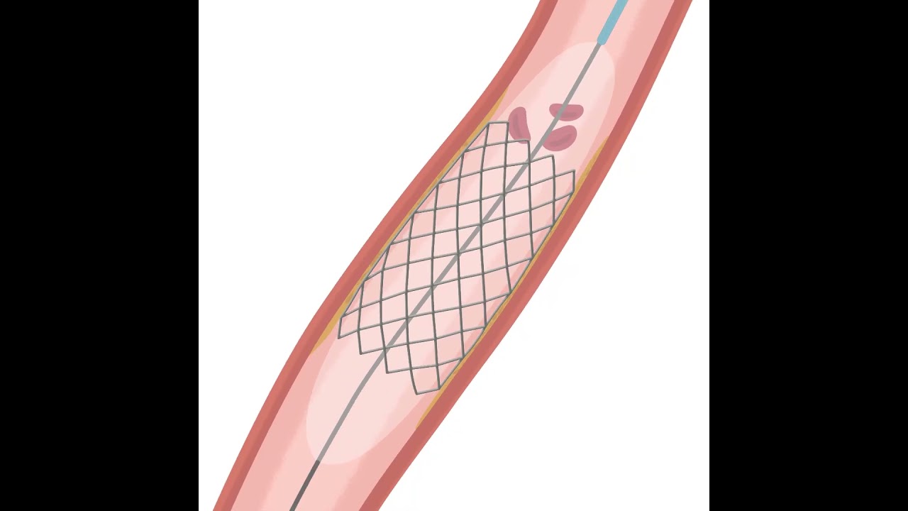 Percutaneous Coronary Intervention (PCI)