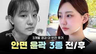 [리얼모델 VLOG] ✔️라인 여신 됐어요! 똥글똥글 얼굴 대탈출｜윤곽 3종, 턱+심부볼 지흡 3개월 리얼 후기 ???? #일퍼센트성형외과