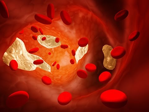 comment guerir cholesterol