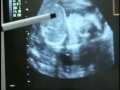 Smoking Ultrasound