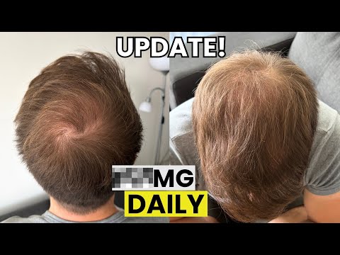 Finasteride Microdosing Update 2025!