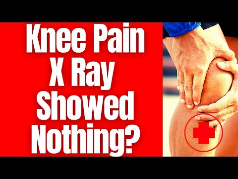 Knee Pain X Ray Showed Nothing✔️  www.EaseKneePain.com #kneepain #xray #kneexray #shorts #