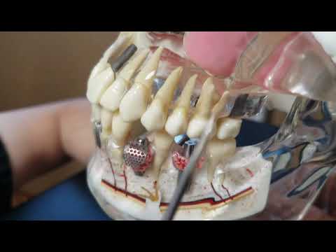 Maxillary Sinus Lift in Implant Dentistry (Intracrestal &/or Lateral)- 101