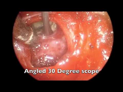 Endoskopowa operacja przysadki - wykorzystanie endoskopu kątowego
