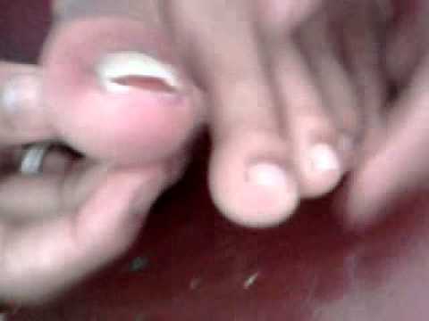 Fungus toenails bleach Alisin ang halamang-singaw mula sa mga pader sa apartment para sa lahat ng mga remedyo folk