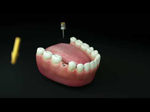 Dentis Bone Profiler Kit ｜DENTIS USA