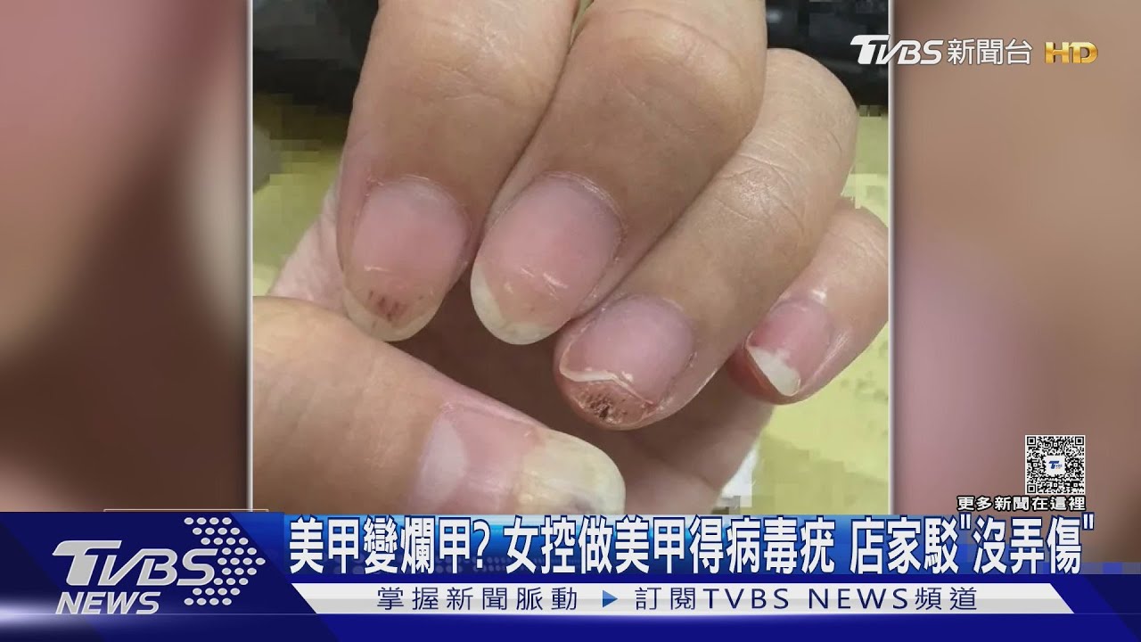 美甲變爛甲?女控「器材不乾淨」染病毒疣 台中店家否認:願陪同就醫