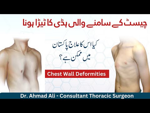 Rib Fracture Recovery