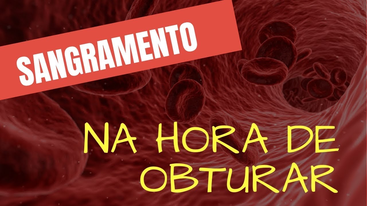 COMO PARAR O SANGRAMENTO DO CANAL PARA OBTURAR EM SESSÃO ÚNICA? - ENDOLOVERS