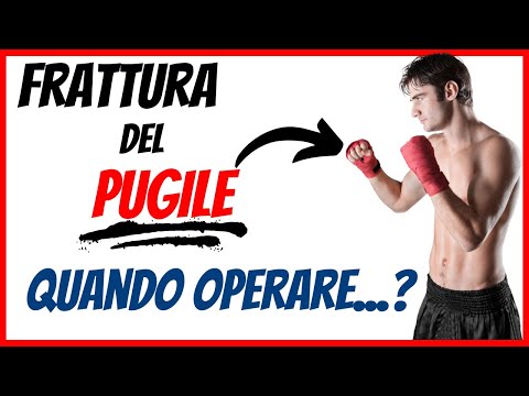 Frattura del pugile (frattura del quinto metacarpo) 👊 Quando OPERARE?