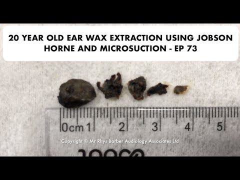 20 YEAR OLD EAR WAX REMOVAL USING JOBSON HORNE AND MICROSUCTION - EP 73