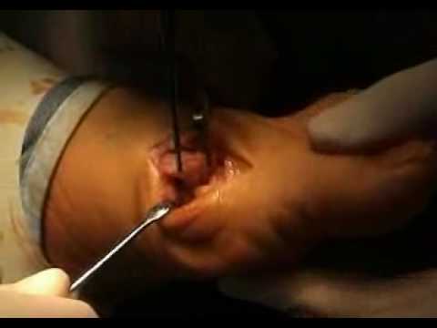 Cibo con osteocondrosi cervicale Corsetti per la colonna vertebrale in osteocondrosi della colonna cervicale