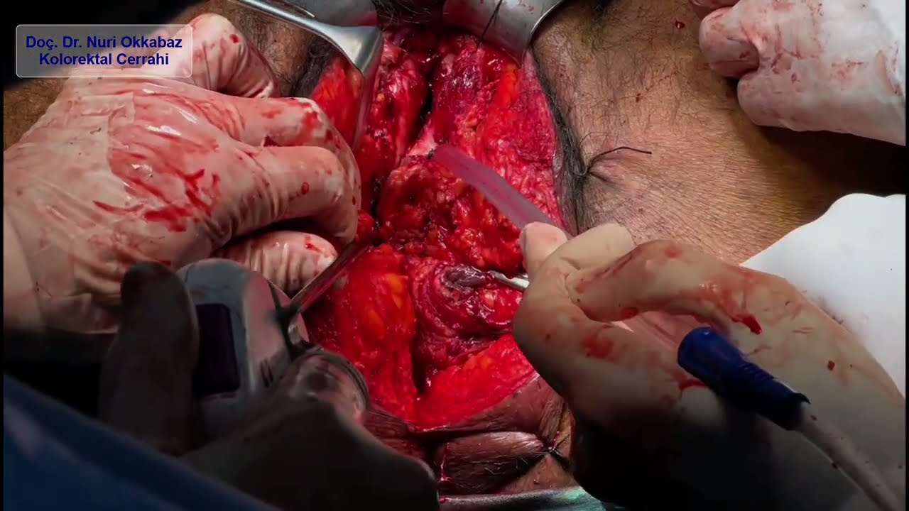 Rectal Cancer – Pelvic Exenteration