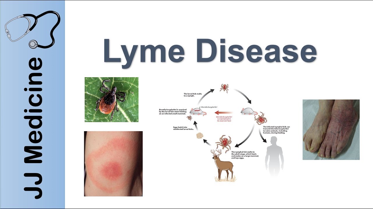 Lyme Disease | Pathophysiology, Signs, and Treatment