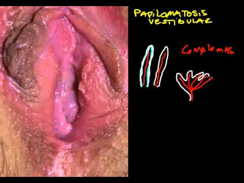 Papilloma virus chez l homme