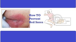 How to Prevent Bed Sores -Pressure Ulcer Prevention - How to Prevent Bed Sores for a Sick Patient