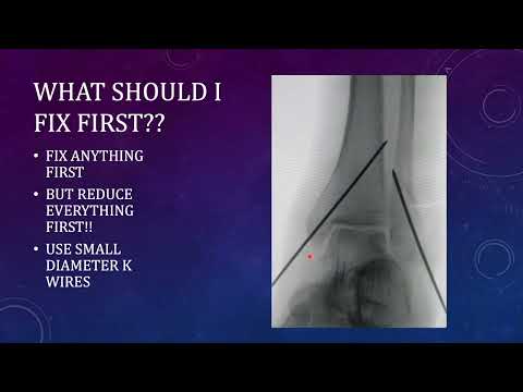 Bimalleolar/Ankle Fractures: Some Tips to Avoid Malalignment