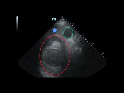 Massive Traumatic Retroperitoneal Hematoma, US 1, Annotated