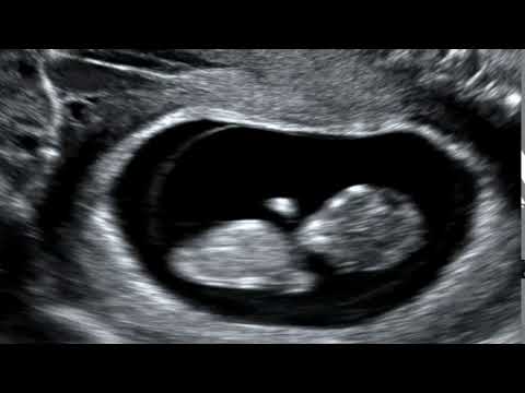 10 weeks 1 day child moving in womb during ultrasound examination