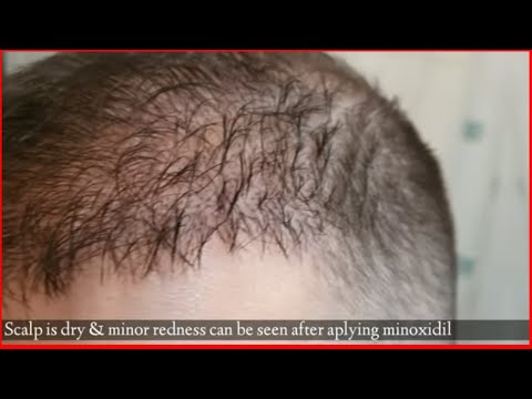 minoxidil hipertónia