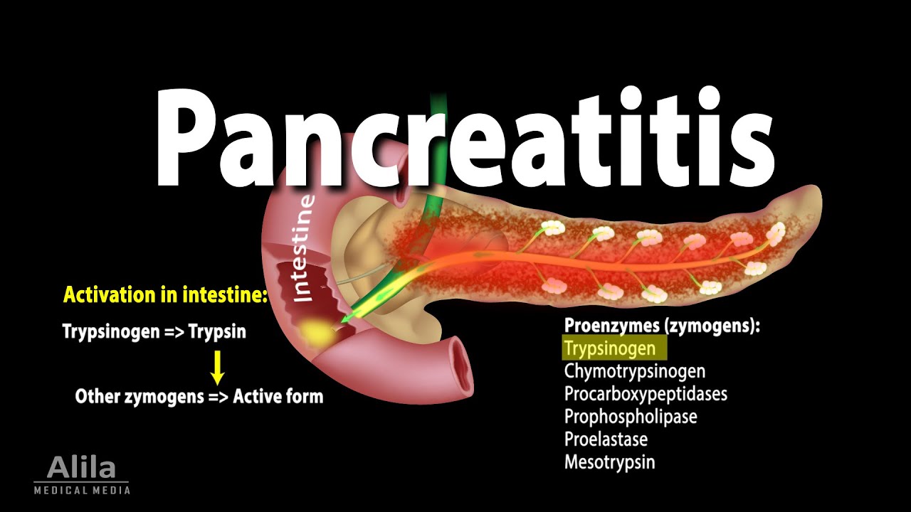 Pancreatitis, Acute and Chronic, Animation