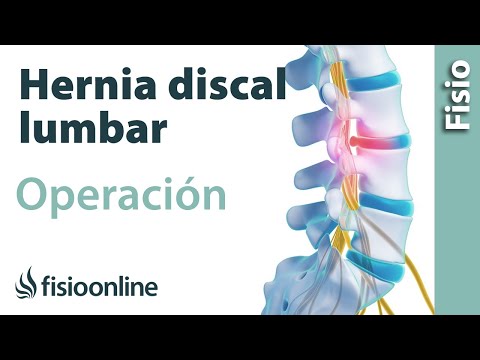 Dolore addominale cronico in osteocondrosi Che fa male nel lato sinistro della parte inferiore della schiena