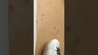 Remove blackheads #shortvideo #skincare #blackhead #satisfying #blackheadremoval