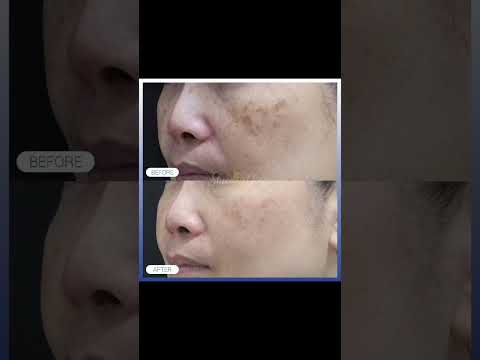Fade Melasma & Pigmentation | Dermapen 4 Microneedling