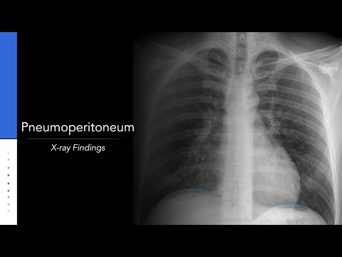 Pneumoperitoneum: Explanation of X-ray Findings
