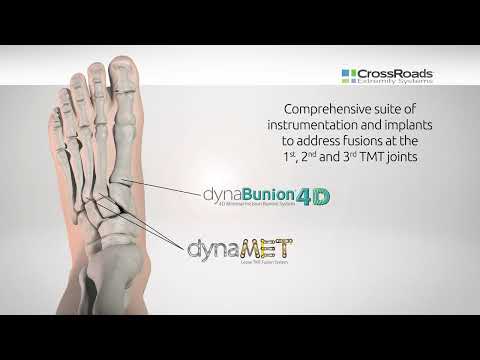 The Power of dynaBunion® 4D + dynaMet™ for Any TMT Fusion
