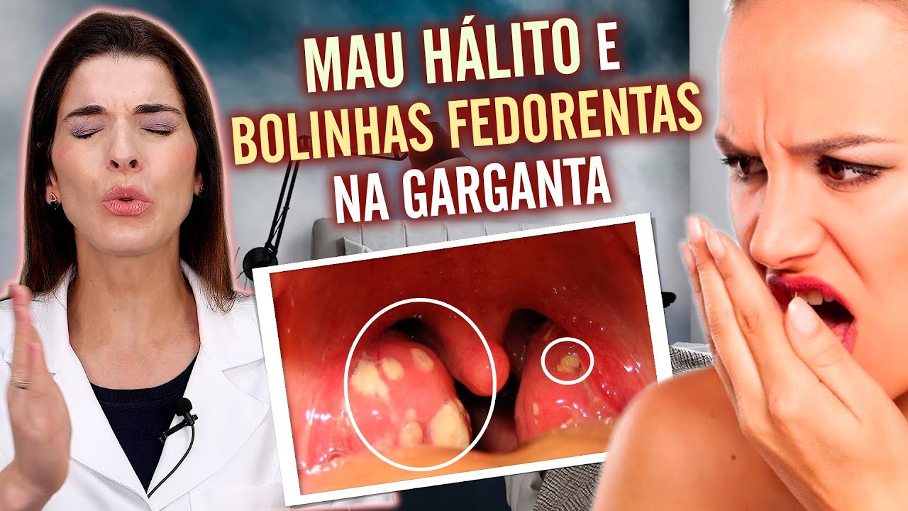ACABE com as Bolinhas Fedorentas da Garganta e o MAU HÁLITO