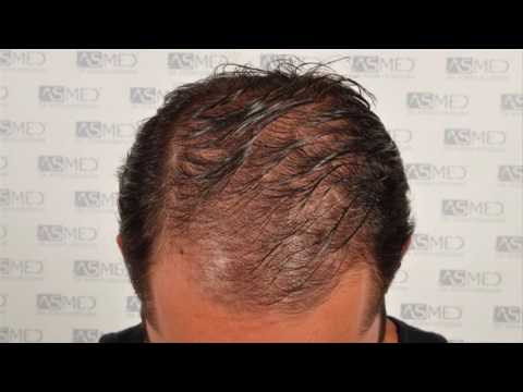 Manual FUE Hair Transplant Before & After, 5004 Grafts Result - ASMED - Dr. Koray Erdogan