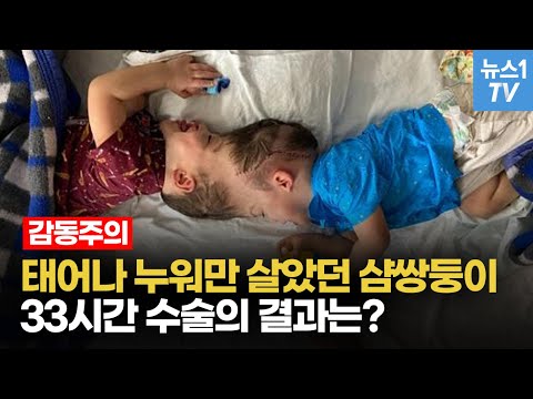 [영상] 머리 붙어 태어난 샴쌍둥이, 33시간의 수술 끝에 분리 성공 - 뉴스1