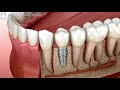 Animated Dental Implant Procedure Apollo Medical Travel