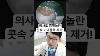 의사도 깜짝놀란 콧속 거대물혹 제거!