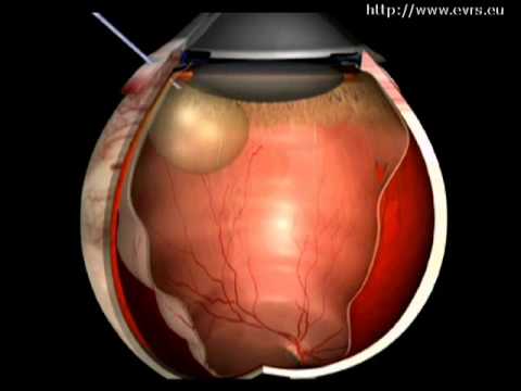 Application de mesure de la pression sanguine pour iphone Sovmostimost Valz et amlodipine
