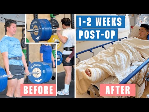 Week 1: Achilles Tendon Rupture Surgery and Recovery & Tips and Lessons