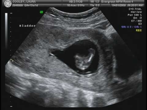 Ultrasound Healthy baby boy 13 weeks