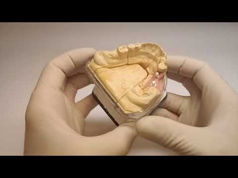 Zahntechnischer Workflow - Bicon: Teil 4 Abutmentauswahl B