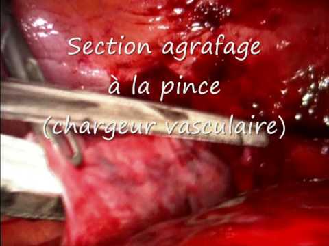 comment traiter les trompes bouchées