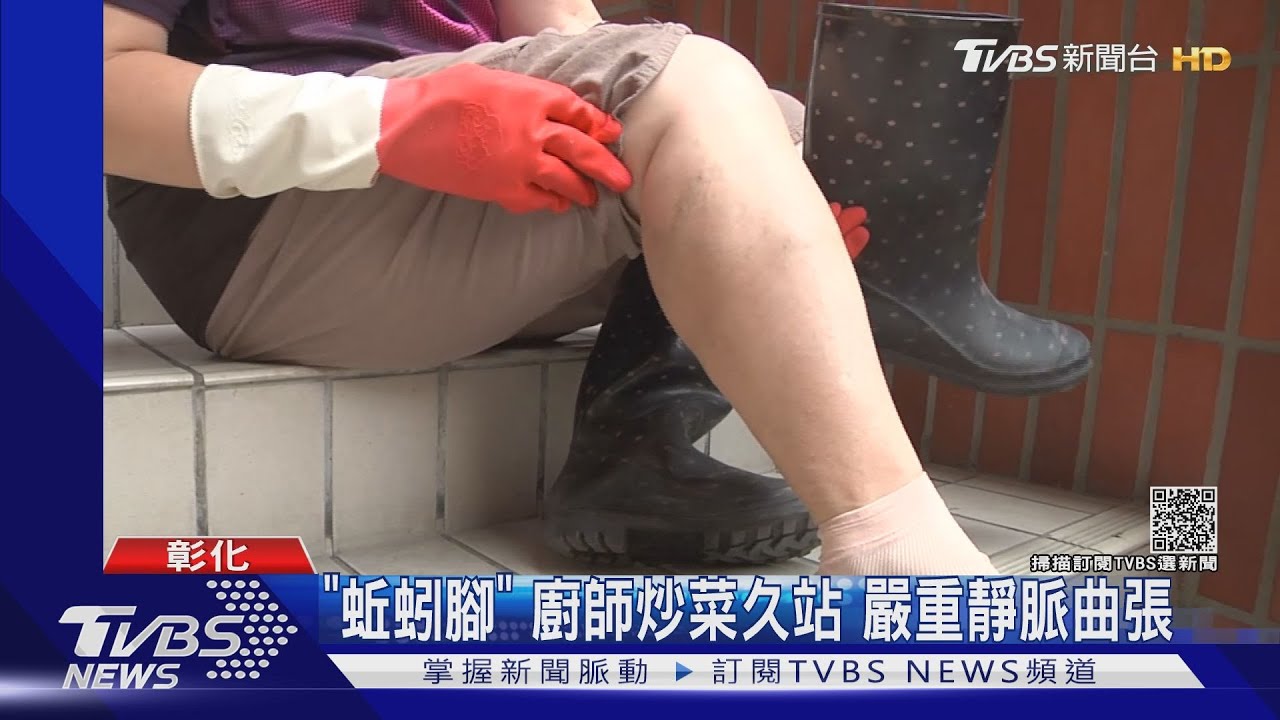 「蚯蚓腳」廚師炒菜久　嚴重靜脈曲張