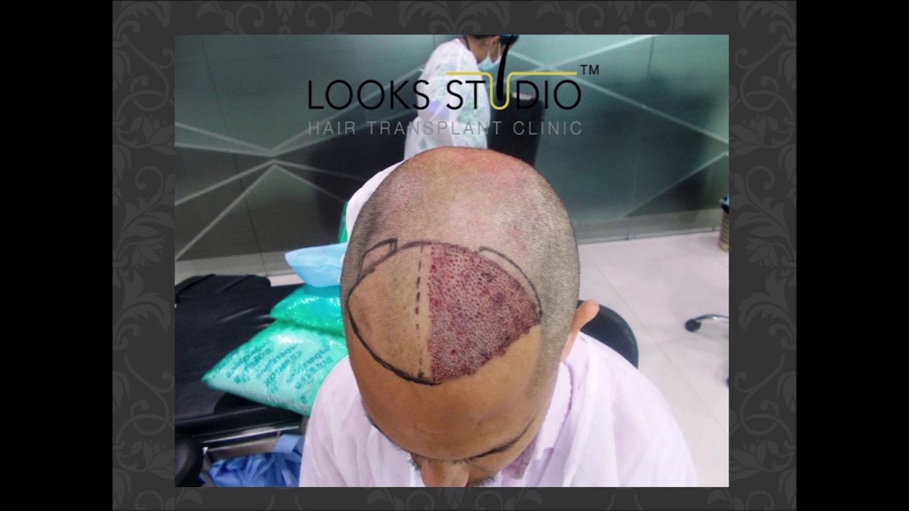 HAIR TRANSPLANT RESULTS, 3000 GRAFTS Grade 3, LOOKS STUDIO