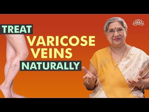 Treat Varicose Veins Naturally with 5 Powerful Yoga Asanas | Leg Pain Relief | Better Blood Flow