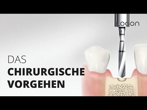 LOGON Implantate: Das chirurgische Vorgehen