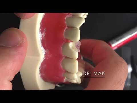 Clinical Demonstration for the CLASS IV Composite Technique.