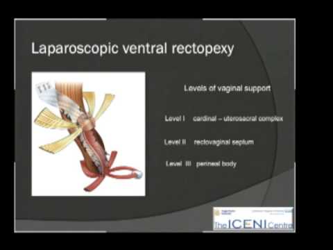 Laparoscopic Approaches to Rectal Prolapse