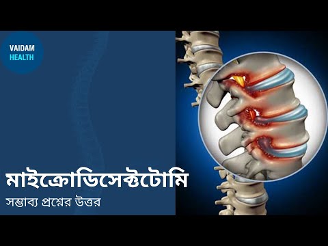 মাইক্রোডিসেক্টমি- প্রায়শই জিজ্ঞাসিত প্রশ্ন